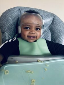 cranial-remolding-5