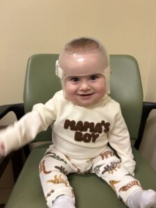 cranial-remolding-23